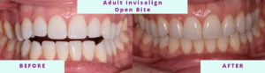 Invisalign Before & After