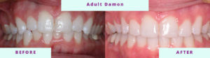 Invisalign Before & After