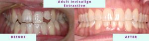 Invisalign Before & After