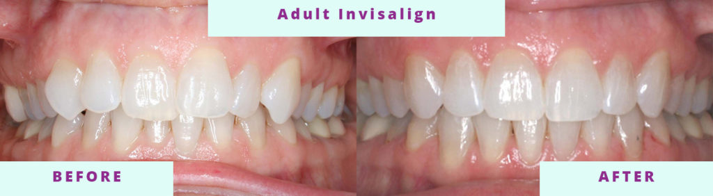 invisalign for adults before and after 