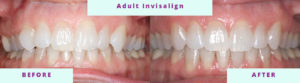 Invisalign Before & After