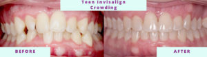 Invisalign Before & After