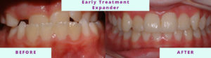 Early Treatment Before & After