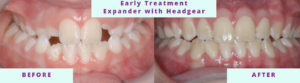 Early Treatment Before & After