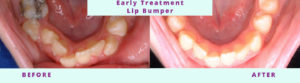 Early Treatment Before & After