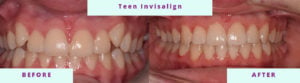 Invisalign Before & After