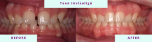 Invisalign Before & After