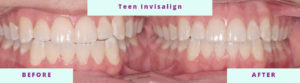 Invisalign Before & After